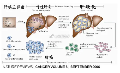 肝硬化最新治疗方法探讨与解析